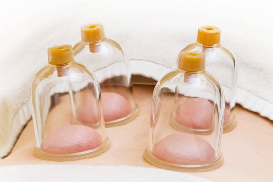 Cupping Therapy Center 